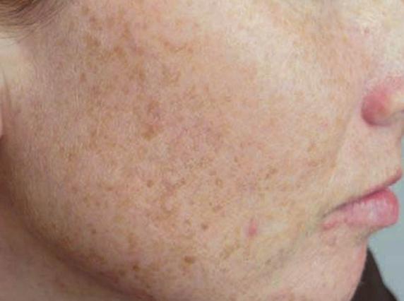 Senile Plaque (Age Spots) Treatment