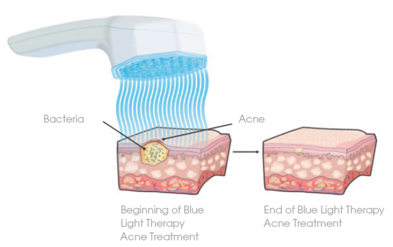 blue-light-therapy-acne-treatment