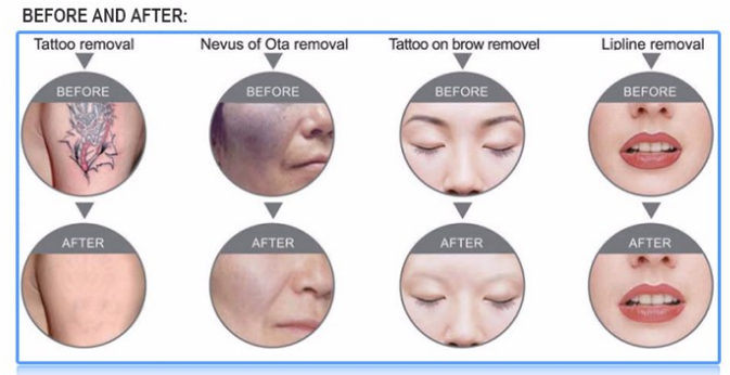 Laser cosmetic treatment problem