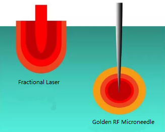 Golden RF microneedle