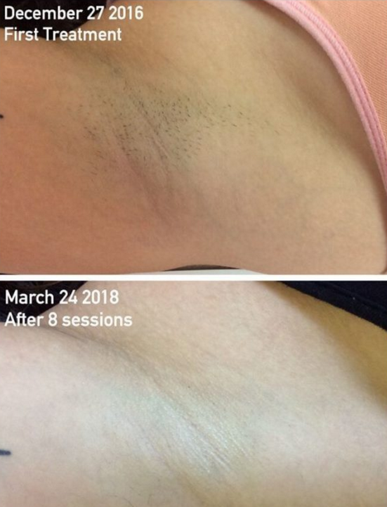 10 things you need to know before laser hair removal