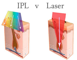 IPL and Laser