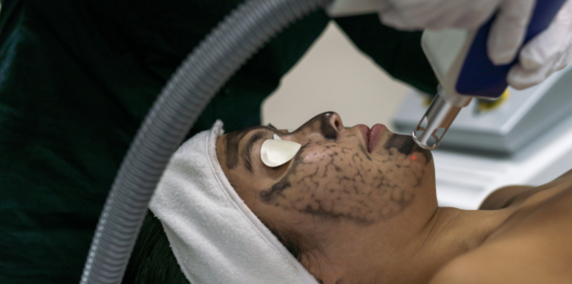 During the Carbon facial treatment