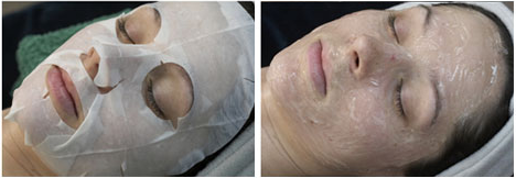  During the CO2 Fractional Laser