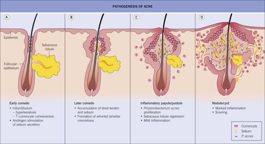 Acne Treatment - ChoicyBeauty Laser