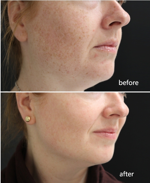 bbl-laser-before-and-after-1-treatment.jpg