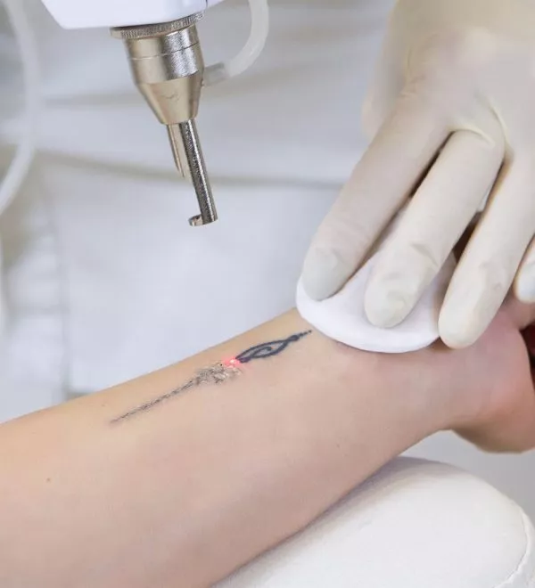 Formación sobre el tratamiento de eliminación de tatuajes
