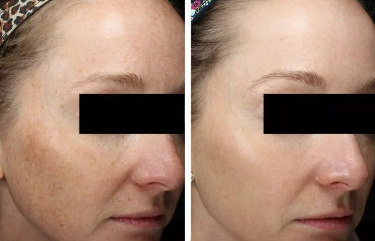 bbl-laser-before-and-after.jpg