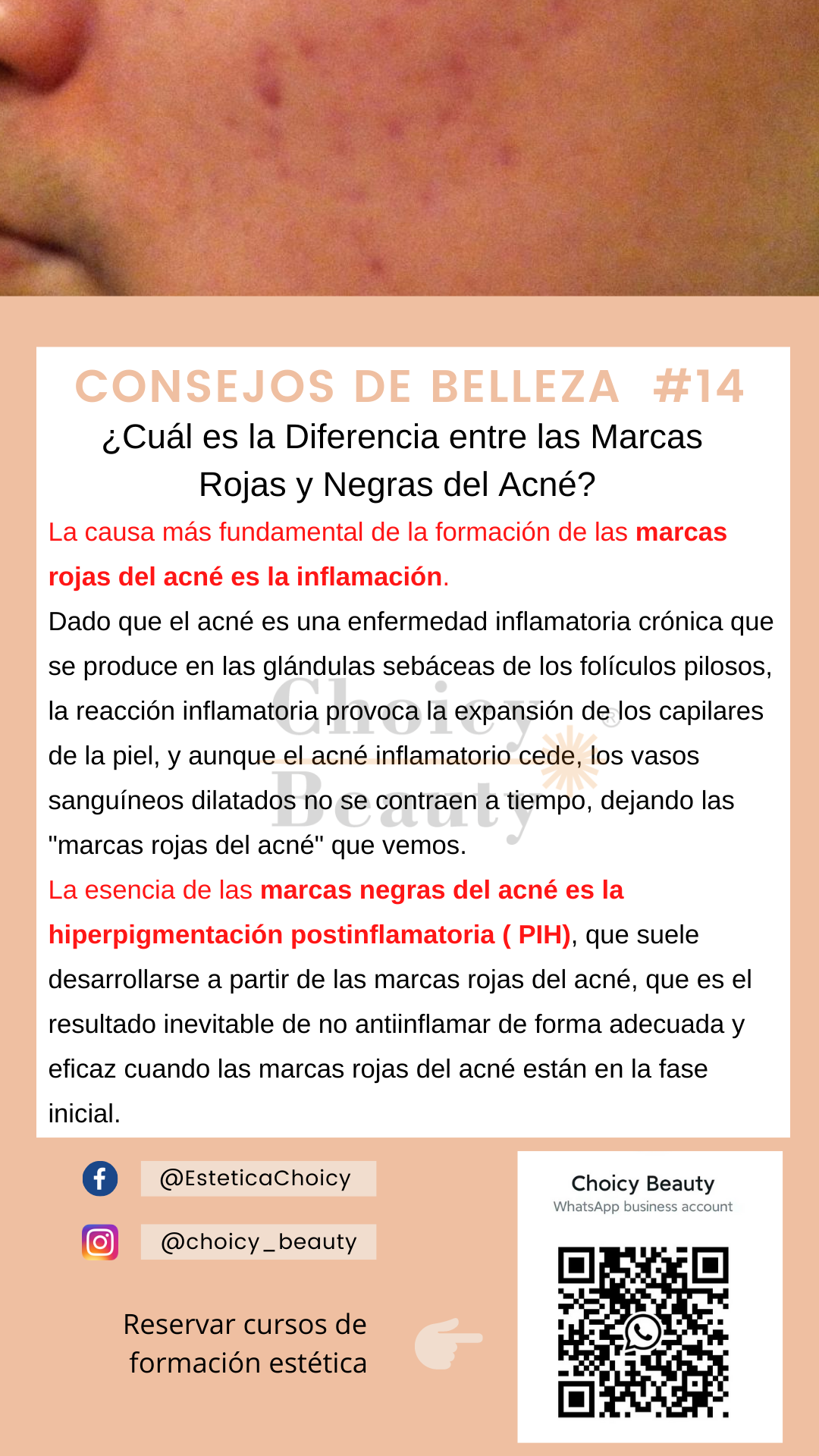 Marcas Rojas La diferencia entre las marcas rojas y negras acne